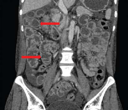 Contrast-enhanced computed tomography scan of abdomen showing jejunoileal folds pattern reversal: Featureless jejunal loops (upper red arrow) and increased mucosal folds in the ileal loops (lower red arrow).